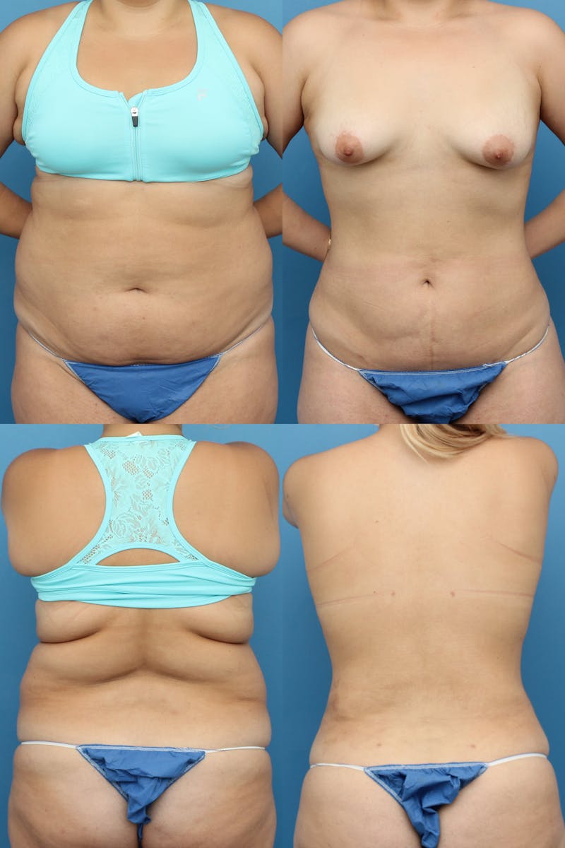 Liposuction Before & After Gallery - Patient 74008057 - Image 1