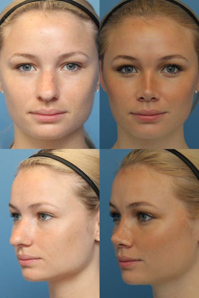 Female Bulbous Tip Before & After Gallery - Patient 79813455 - Image 1