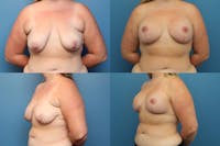 Reductive Augmentation of the Breast Before & After Gallery - Patient 79813591 - Image 1