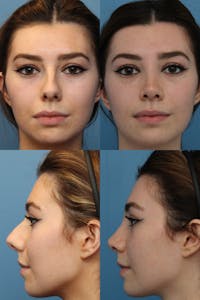 Female Bulbous Tip Before & After Gallery - Patient 82269101 - Image 1