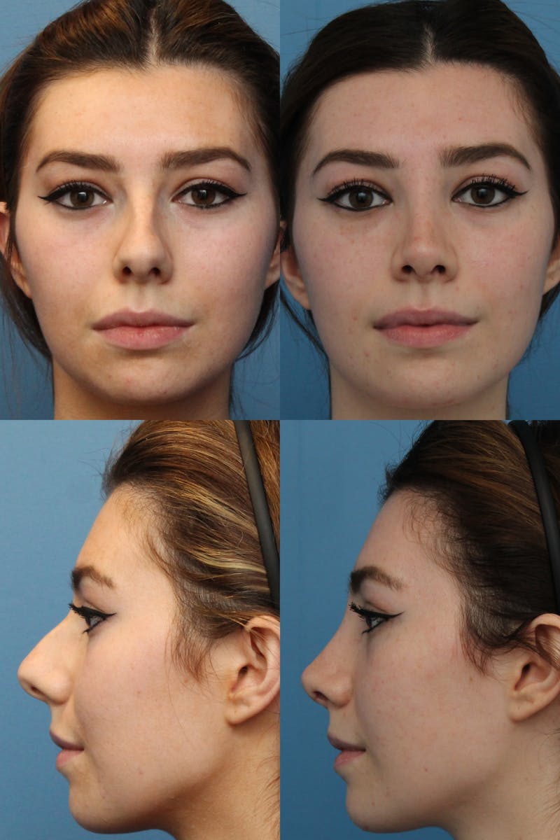 Female Bulbous Tip Before & After Gallery - Patient 82269101 - Image 1