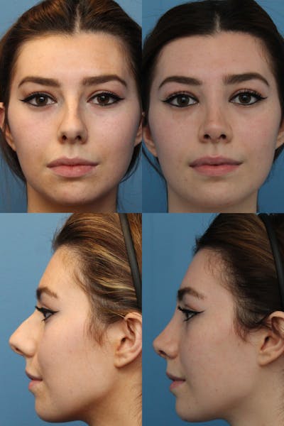 Female Bulbous Tip Before & After Gallery - Patient 82269101 - Image 1