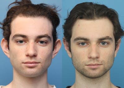 Dr. Francis Otoplasty Before & After Gallery - Patient 83200779 - Image 1