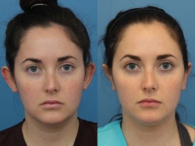 Dr. Francis Otoplasty Before & After Gallery - Patient 83200780 - Image 1