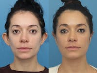Dr. Francis Otoplasty Before & After Gallery - Patient 83200782 - Image 1