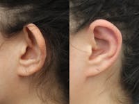 Dr. Francis Otoplasty Before & After Gallery - Patient 83201225 - Image 1