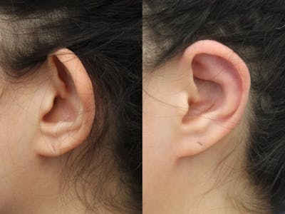 Dr. Francis Otoplasty Before & After Gallery - Patient 83201225 - Image 1