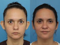 Dr. Francis Otoplasty Before & After Gallery - Patient 83200783 - Image 1