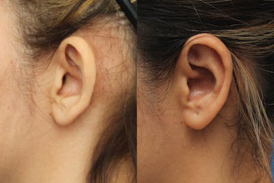 Dr. Francis Otoplasty Before & After Gallery - Patient 83201226 - Image 1