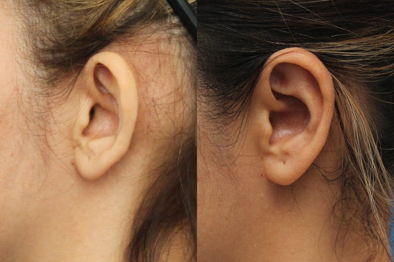 Dr. Francis Otoplasty Before & After Gallery - Patient 83201226 - Image 1