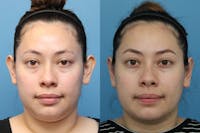Dr. Francis Otoplasty Before & After Gallery - Patient 83200784 - Image 1