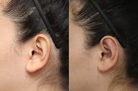 Dr. Francis Otoplasty Before & After Gallery - Patient 83201227 - Image 1