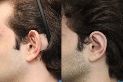 Dr. Francis Otoplasty Before & After Gallery - Patient 148701573 - Image 1