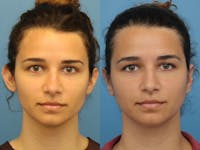 Dr. Francis Otoplasty Before & After Gallery - Patient 83200785 - Image 1
