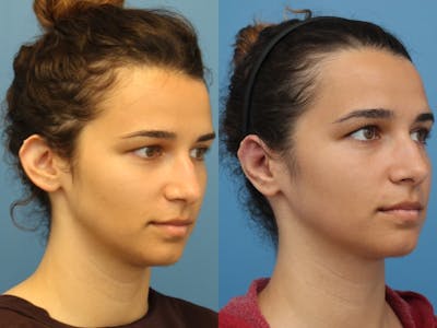Dr. Francis Otoplasty Before & After Gallery - Patient 148702860 - Image 1