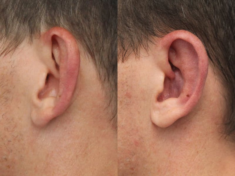 Dr. Francis Otoplasty Before & After Gallery - Patient 83200787 - Image 1