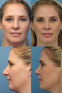 Female Prominent Nostril / Hanging Columella Before & After Gallery - Patient 87381630 - Image 1