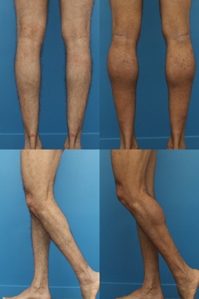 Calf Augmentation Before & After Gallery - Patient 93318045 - Image 1