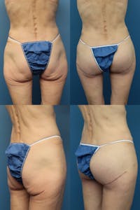 Buttock Augmentation with Implants Gallery - Patient 115250684 - Image 1