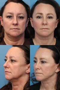 Brow Lift Before & After Gallery - Patient 119497613 - Image 1