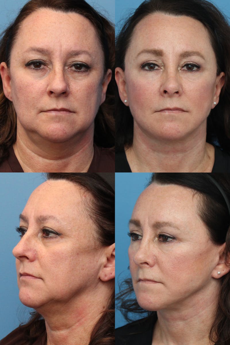Eyelid Surgery (Blepharoplasty) Before & After Gallery - Patient 119497648 - Image 1