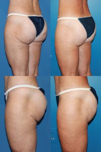 Infragluteal Thigh Lift / Thong Lift Gallery - Patient 120902106 - Image 1