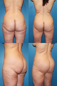 Infragluteal Thigh Lift / Thong Lift Gallery - Patient 120902107 - Image 1