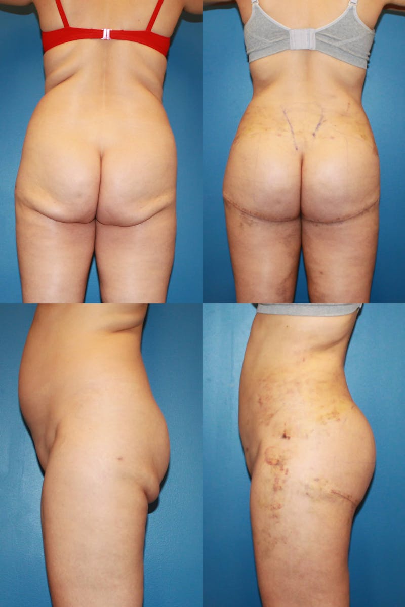 Infragluteal Thigh Lift Before & After Gallery - Patient 120902108 - Image 1