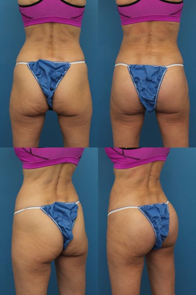 Buttock Augmentation with Implants Gallery - Patient 121258013 - Image 1