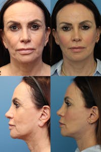 Face Lift Before & After Gallery - Patient 121461211 - Image 1