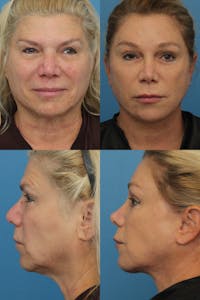 Face Lift Before & After Gallery - Patient 4882497 - Image 1