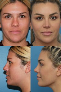 Neck Liposuction Before & After Gallery - Patient 121500498 - Image 1