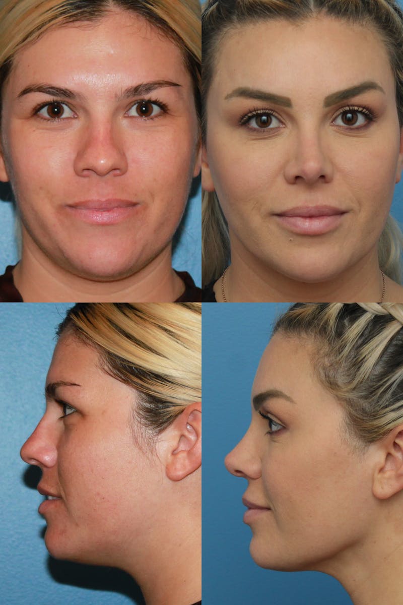 Female Rhinoplasty Before & After Gallery - Patient 121500502 - Image 1