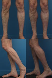 Calf Augmentation Before & After Gallery - Patient 121544234 - Image 1