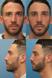 Male Rhinoplasty Before & After Gallery - Patient 121544243 - Image 1