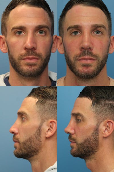 Male Rhinoplasty Before & After Gallery - Patient 146343828 - Image 1