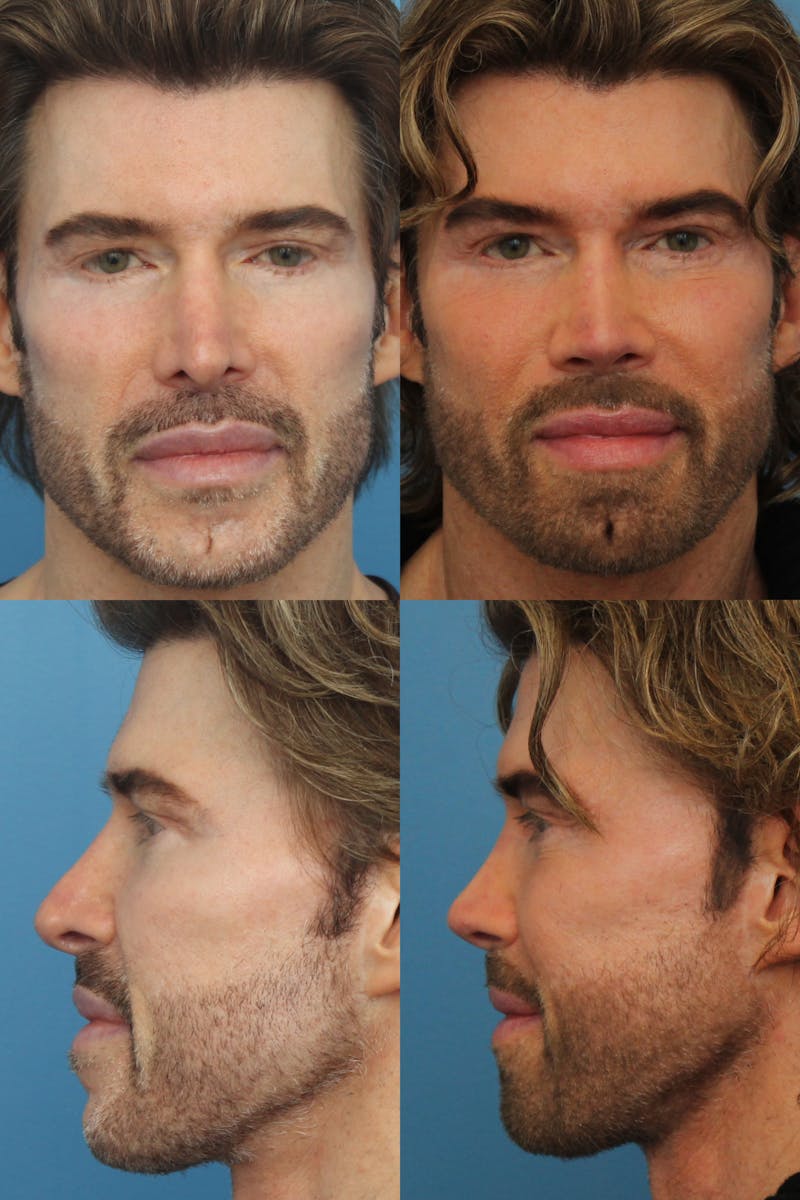 Male Rhinoplasty Before & After Gallery - Patient 121544244 - Image 1