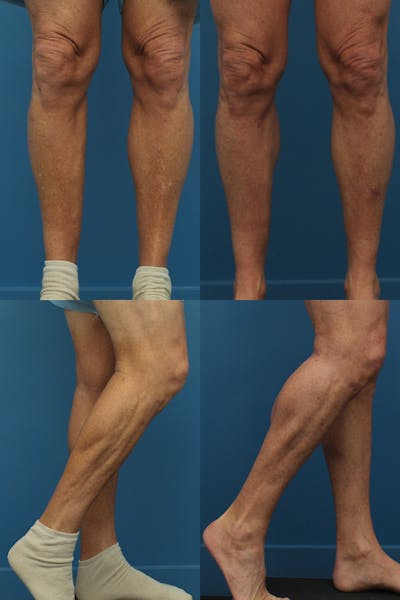 Calf Augmentation Before & After Gallery - Patient 121544246 - Image 1