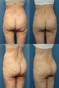 Thong Lift / Infragluteal Thigh Lift  Before & After Gallery - Patient 121764744 - Image 1