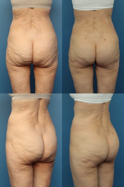 Thong Lift / Infragluteal Thigh Lift  Before & After Gallery - Patient 121764744 - Image 1