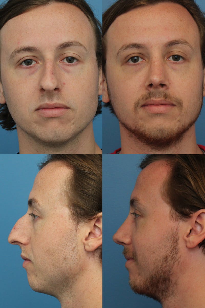 Male Rhinoplasty Before & After Gallery - Patient 122127334 - Image 1