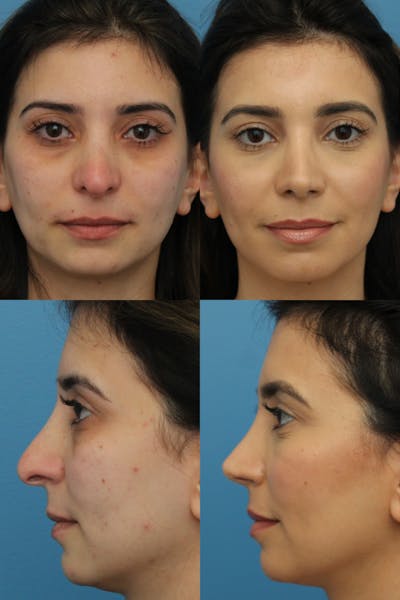 Female Revision Rhinoplasty Before & After Gallery - Patient 122127336 - Image 1