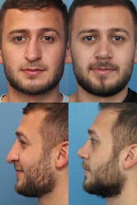 Male Rhinoplasty Before & After Gallery - Patient 146343826 - Image 1