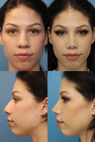 Female Dorsal Hump Before & After Gallery - Patient 122343379 - Image 1