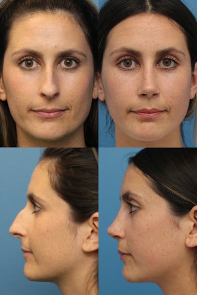 Female Bulbous Tip Before & After Gallery - Patient 122404206 - Image 1