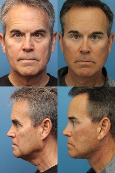 Face Lift Before & After Gallery - Patient 122706586 - Image 1
