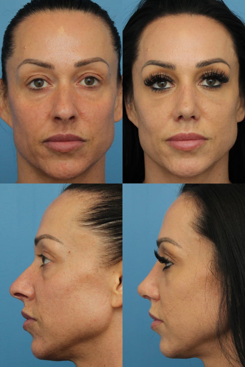 Female Prominent Nostril / Hanging Columella Before & After Gallery - Patient 122771403 - Image 1