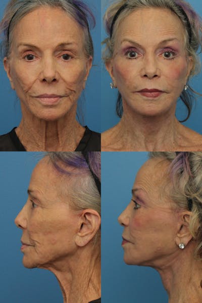 Facelift Before and After  Ranch & Coast Plastic Surgery