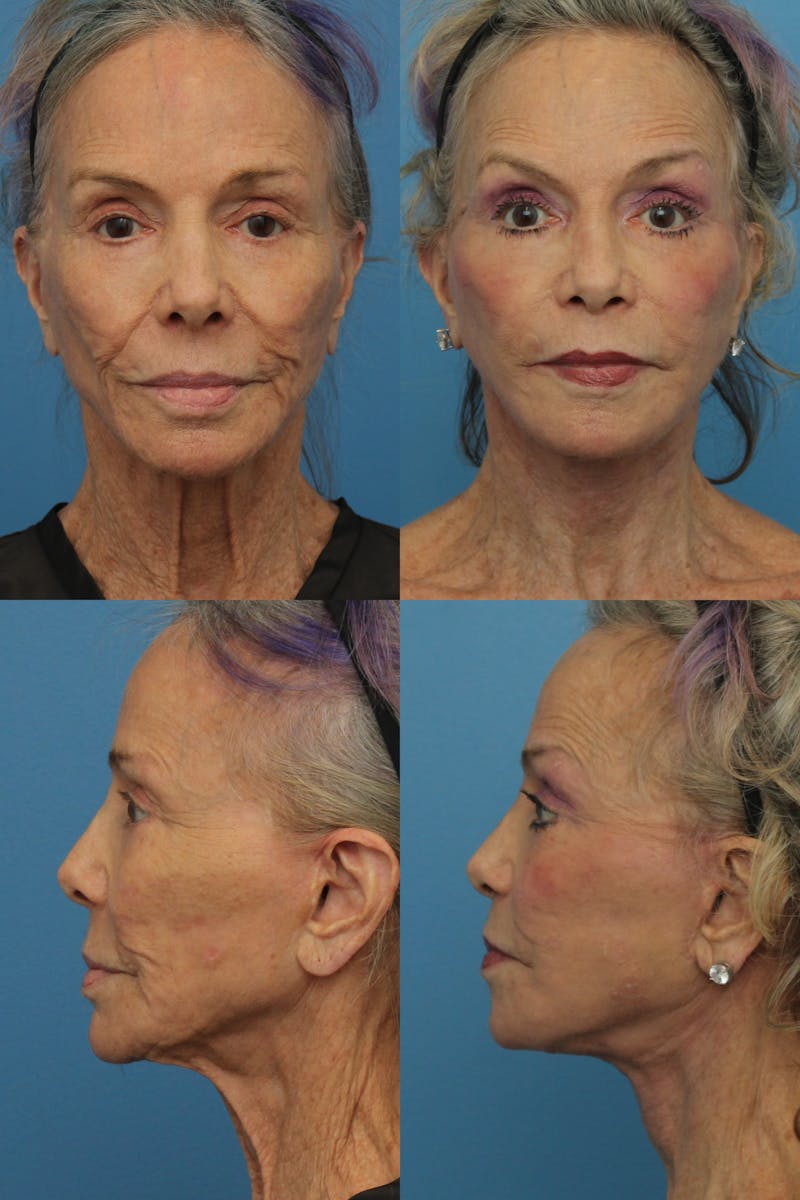 Face Lift Gallery - Patient 122771409 - Image 1