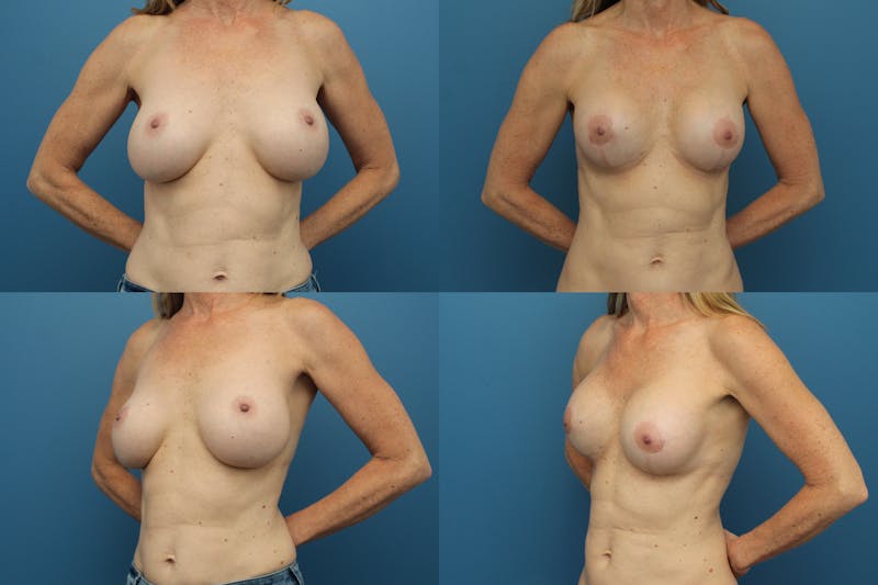 Mal-position- Inferior and/or Lateral Before & After Gallery - Patient 122976425 - Image 1